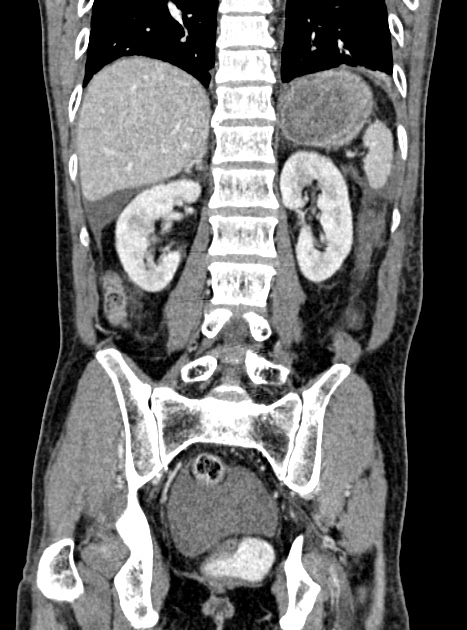 Acute bowel ischemia (Radiopaedia 87695-104114 Coronal C+ portal venous phase 270).jpg
