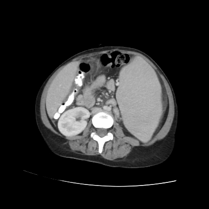 Acute calculous cholecystitis in patient with osteopetrosis (Radiopaedia 77871-90159 Axial C+ portal venous phase 47).jpg