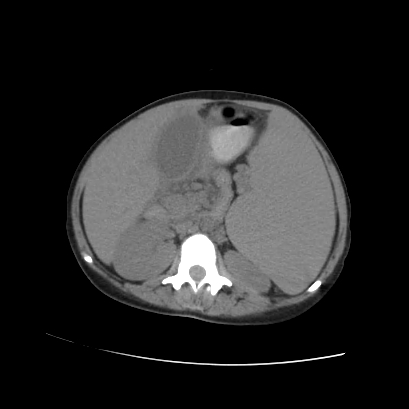 File:Acute calculous cholecystitis in patient with osteopetrosis (Radiopaedia 77871-90159 Axial non-contrast 39).jpg