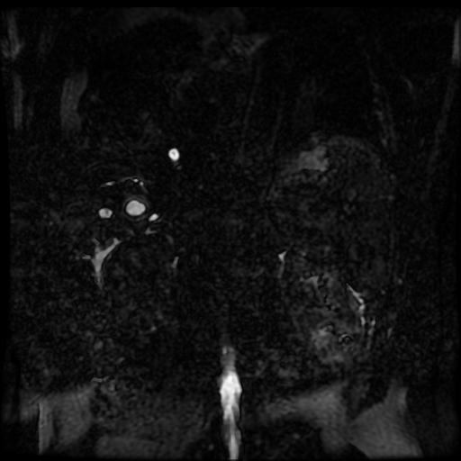 Acute cholecystitis and biliary hamartomas (Radiopaedia 86231-102240 E 8).jpg