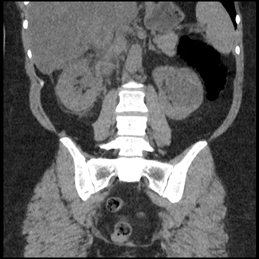 Acute cholecystitis and ureteric colic (Radiopaedia 42330-45444 Coronal prone 67).jpg