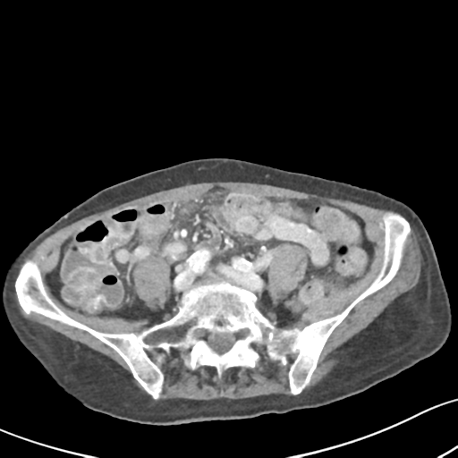 Acute cholecystitis with contained perforation (Radiopaedia 47328-51907 Axial C+ portal venous phase 48).png