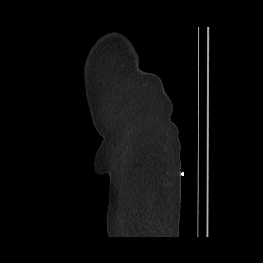Acute cholecystitis with tensile fundus sign (Radiopaedia 71394-81723 Sagittal non-contrast 20).jpg