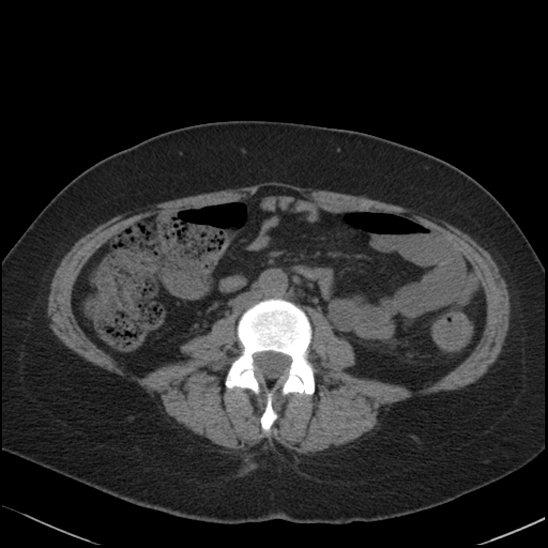 Acute colonic hemorrhage in ulcerative colitis (Radiopaedia 77415-89538 Axial non-contrast 75).jpg