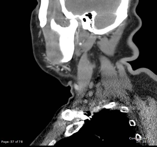 Acute epiglottitis (Radiopaedia 54375-60590 Sagittal C+ arterial phase 57).jpg