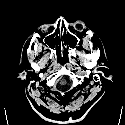 File:Acute left middle cerebral artery territory ischemic stroke (Radiopaedia 35688-37223 Axial non-contrast 1).png