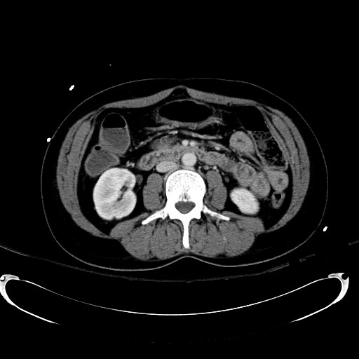 Acute myocardial infarction in CT (Radiopaedia 39947-42415 Axial C+ portal venous phase 63).jpg
