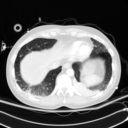 Acute myocardial infarction in CT (Radiopaedia 39947-42415 Axial lung window 110).jpg