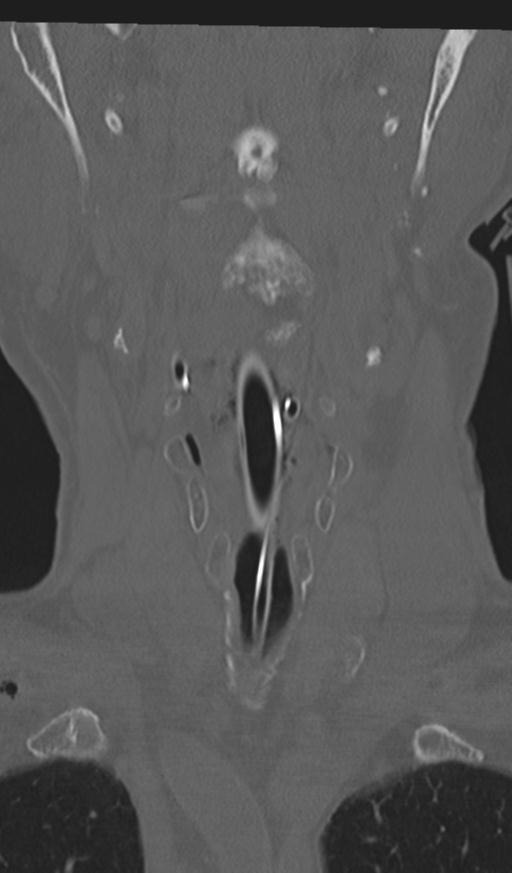 Acute on chronic subdural hematoma and thoracic vertebral injury in a multitrauma patient (Radiopaedia 31698-32619 Coronal bone window 7).jpg