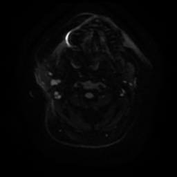 Acute otitis externa (Radiopaedia 57296-64236 Axial DWI 15).jpg