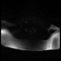 Acute otitis externa (Radiopaedia 57296-64236 Axial DWI 27).jpg