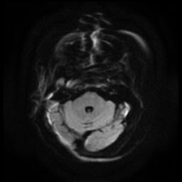 File:Acute otitis externa (Radiopaedia 57296-64236 Axial DWI 5).jpg