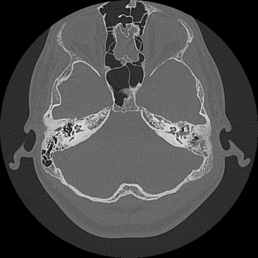 File:Acute otomastoiditis and Bezold abscess (Radiopaedia 88184-104786 Axial bone window 34).jpg