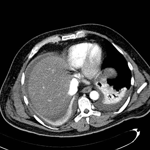 File:Acute pancreatic necrosis (Radiopaedia 13560-13486 Axial C+ portal venous phase 19).jpg