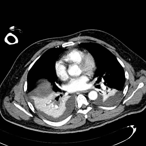 File:Acute pancreatic necrosis (Radiopaedia 13560-13486 Axial C+ portal venous phase 4).jpg