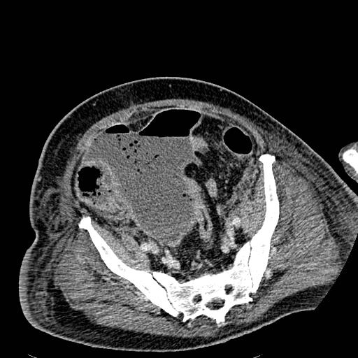 Acute pancreatic necrosis (Radiopaedia 13560-18501 Axial C+ portal venous phase 118).jpg