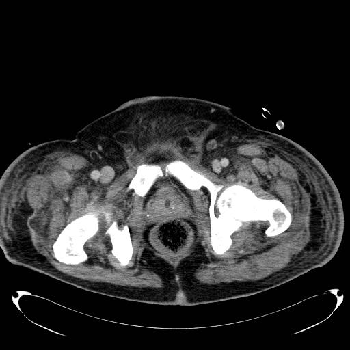 Acute pancreatic necrosis (Radiopaedia 13560-18503 Axial C+ portal venous phase 83).jpg