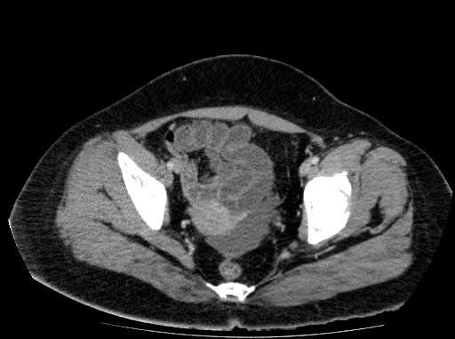 Acute pancreatitis (Radiopaedia 69236-79012 Axial C+ portal venous phase 81).jpg