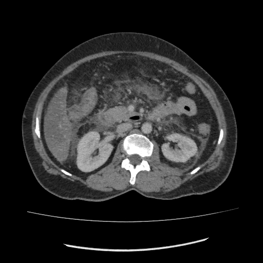 Acute pancreatitis (Radiopaedia 80007-93285 Axial C+ portal venous phase 79).jpg