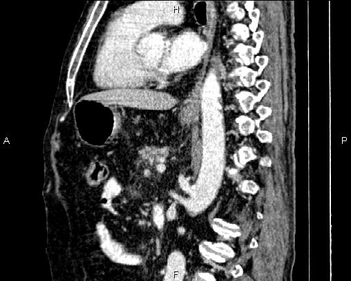 File:Acute pancreatitis (Radiopaedia 85146-100701 Sagittal C+ portal venous phase 53).jpg