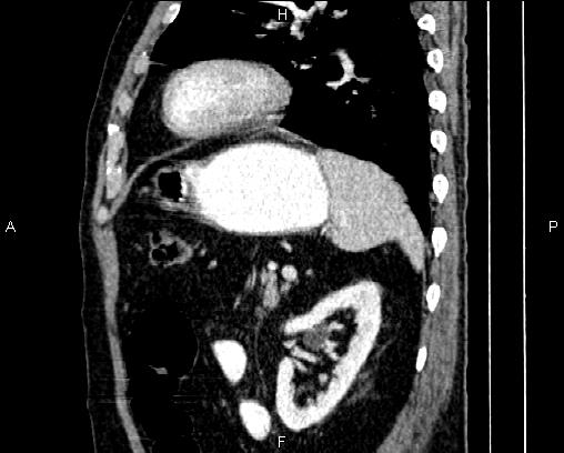 Acute pancreatitis (Radiopaedia 85146-100701 Sagittal C+ portal venous phase 70).jpg