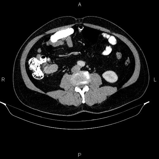 Acute pancreatitis (Radiopaedia 85390-101010 Axial C+ portal venous phase 62).jpg