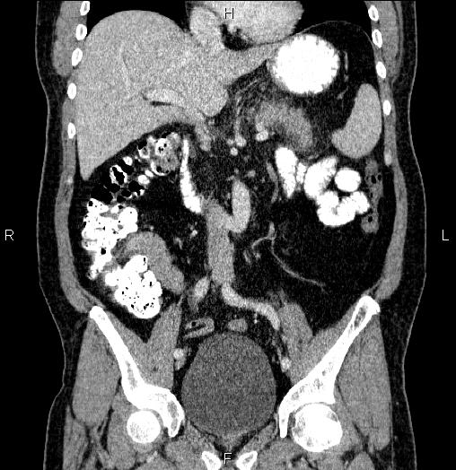 Acute pancreatitis (Radiopaedia 85390-101010 Coronal C+ portal venous phase 35).jpg