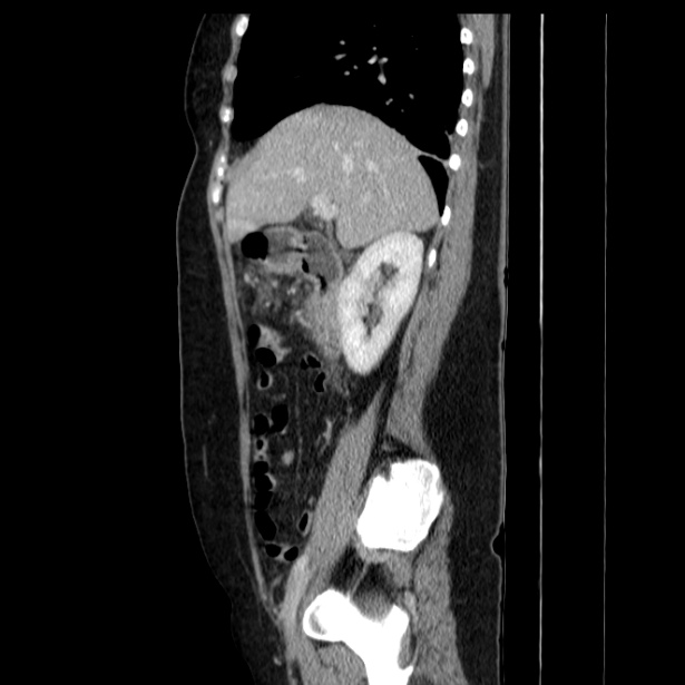 Acute pancreatitis - Balthazar C (Radiopaedia 26569-26714 Sagittal C+ portal venous phase 25).jpg