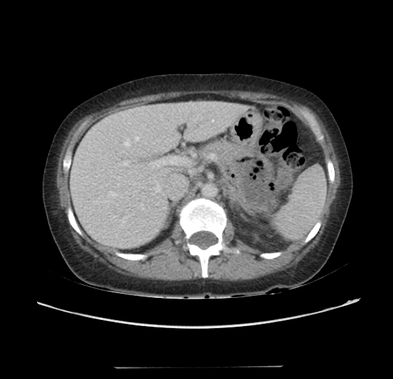 Acute pancreatitis - Balthazar E - post ERCP (Radiopaedia 27562-27772 Axial C+ portal venous phase 23).png