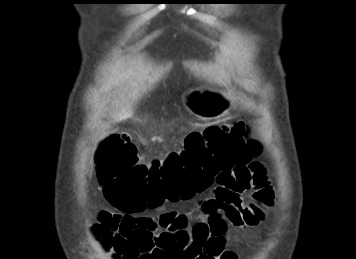 Acute pancreatitis and walled-off necrosis (Radiopaedia 29888-30404 Coronal C+ portal venous phase 8).jpg
