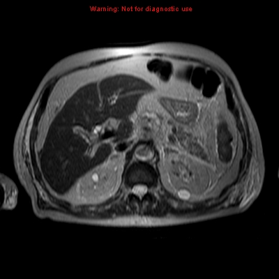 File:Acute pancreatitis with incidental pancreatic lipoma (Radiopaedia 10190-10732 Axial T2 13).jpg