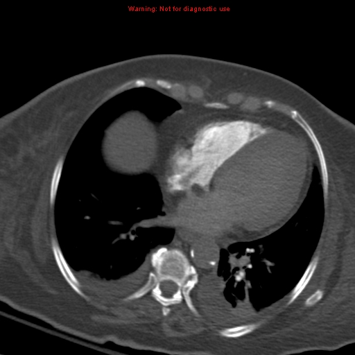 Acute pulmonary embolism (Radiopaedia 13286-13289 Axial C+ CTPA 45).jpg