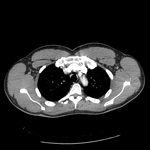 Acute segmental pulmonary emboli and pulmonary infarction (Radiopaedia 62264-70444 Axial C+ CTPA 32).jpg