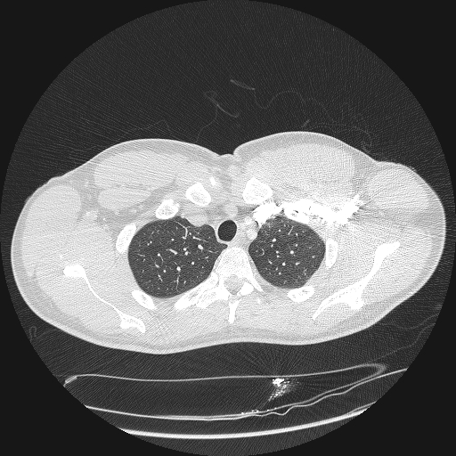 Acute segmental pulmonary emboli and pulmonary infarction (Radiopaedia 62264-70444 Axial lung window 26).jpg