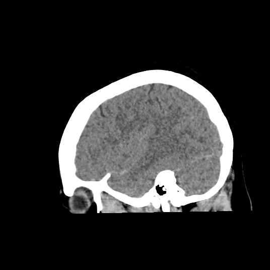 Acute subarachnoid hemorrhage and accessory anterior cerebral artery (Radiopaedia 69231-79008 Sagittal non-contrast 16).jpg