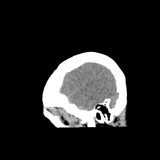 Acute subarachnoid hemorrhage and accessory anterior cerebral artery (Radiopaedia 69231-79008 Sagittal non-contrast 50).jpg
