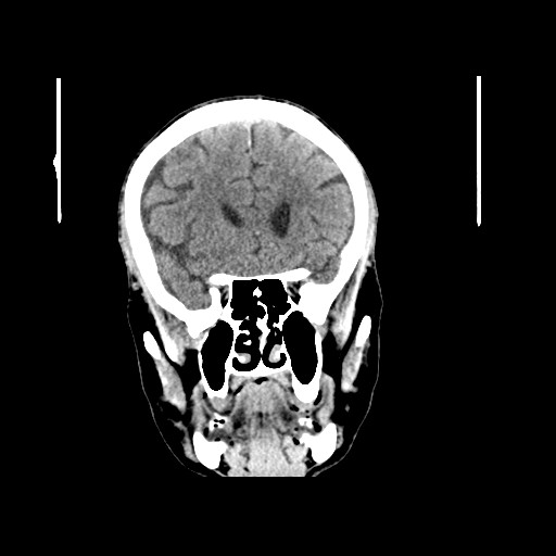 File:Acute superior cerebellar artery territory infarct (Radiopaedia 84104-99359 Axial non-contrast 1).jpg