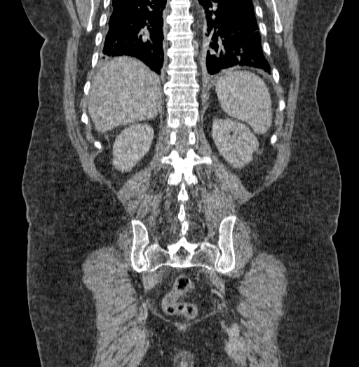 Acute superior mesenteric artery occlusion (Radiopaedia 51288-56960 Coronal C+ portal venous phase 59).jpg