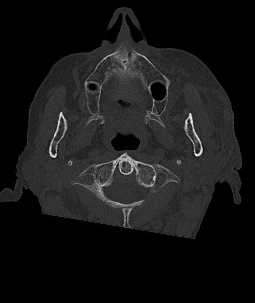 Acute traumatic subdural hematoma (Radiopaedia 82921-97257 Axial bone window 104).jpg