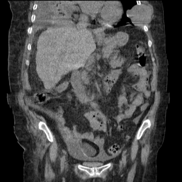 Acute tubular necrosis (Radiopaedia 28077-28334 D 41).jpg