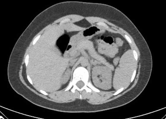 Acute unilateral nonhemorrhagic adrenal infarction (Radiopaedia 67560-76957 Axial non-contrast 34).jpg