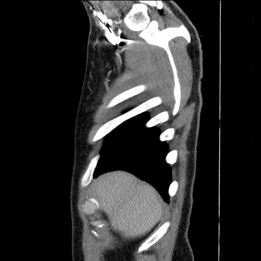 Adenocarcinoma of the lung (Radiopaedia 59871-67325 Sagittal C+ arterial phase 6).jpg