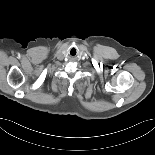 Adenocarcioma of rectum- T1 lesion (Radiopaedia 36921-38547 Axial C+ arterial phase 3).png