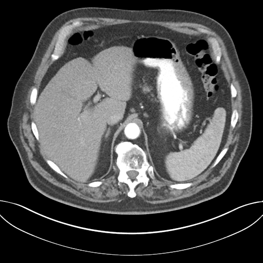 Adenocarcioma of rectum- T1 lesion (Radiopaedia 36921-38547 Axial C+ arterial phase 53).png