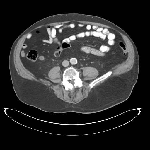 Adenocarcioma of rectum- T1 lesion (Radiopaedia 36921-38547 Axial C+ portal venous phase 55).png