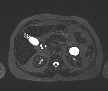 File:Adenomyomatosis of the gallbladder (Radiopaedia 50246-55587 Axial 48).png