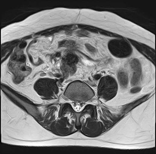 File:Adenomyosis - ovarian endometriomas (Radiopaedia 67031-76350 Axial T2 4).jpg