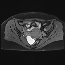 File:Adenomyosis and endometriotic cysts (Radiopaedia 82300-96367 Axial T1 C+ fat sat 17).jpg