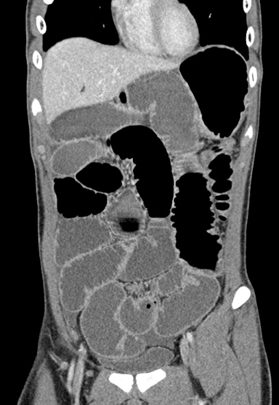 Adhesional small bowel obstruction (Radiopaedia 52107-57980 Coronal C+ portal venous phase 21).jpg