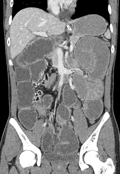 File:Adhesional small bowel obstruction (Radiopaedia 52107-57980 Coronal C+ portal venous phase 39).jpg